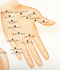 Hand Acupuncture | TCM Health Care Centre